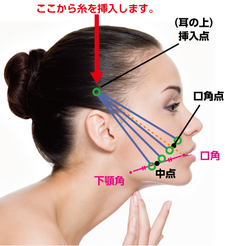 糸リフト（スレッドリフト）とは…