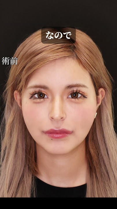 それガーチャー？ほんまゴメンやでnuts専属モデルの今井アンジェリカさんの小顔脂肪吸引を担当しました　#小顔整形 - YouTube