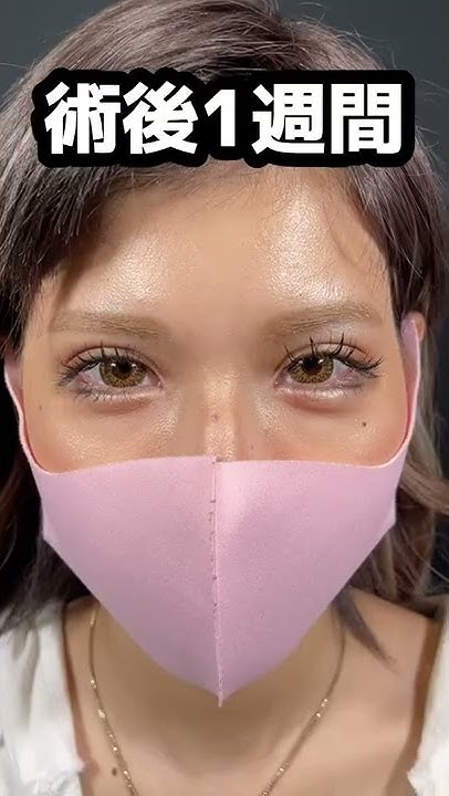 【二重整形】nutsモデルの今井アンジェリカさんを担当させていただきました★ #shorts - YouTube